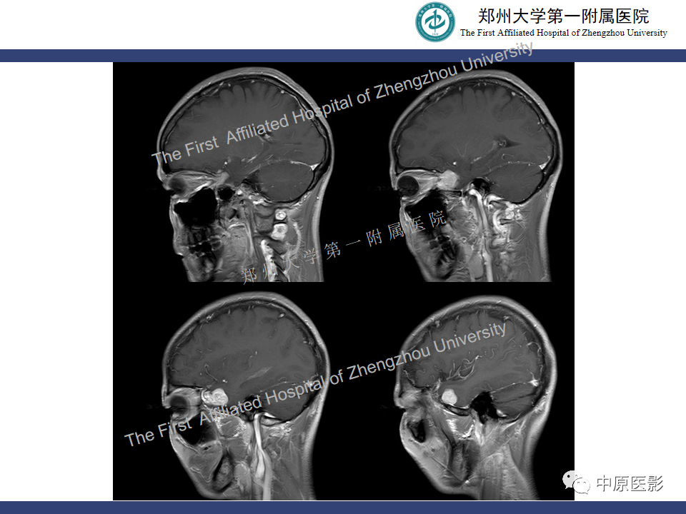 影像PPT - 【病例】颅内软骨肉瘤1例MR影像-9