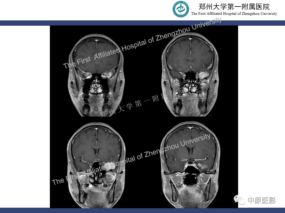 影像PPT - 【病例】颅内软骨肉瘤1例MR影像-10