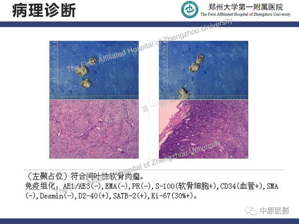 影像PPT - 【病例】颅内软骨肉瘤1例MR影像-12