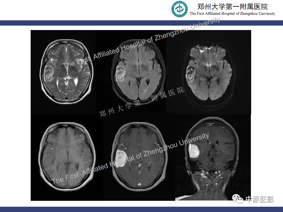 影像PPT - 【病例】颅内软骨肉瘤1例MR影像-18