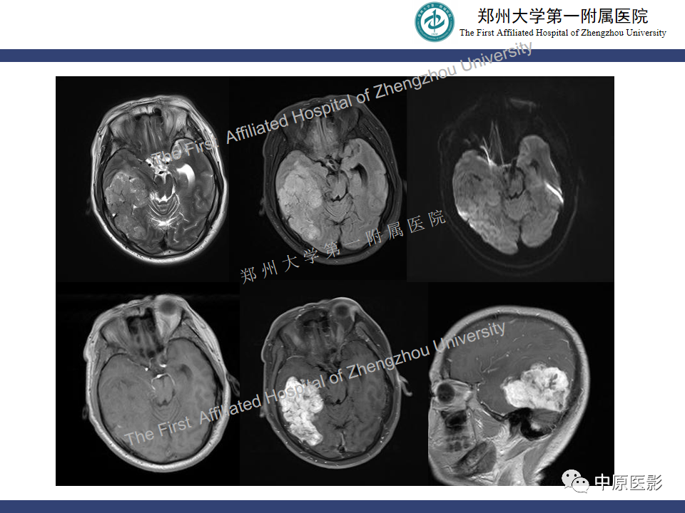 影像PPT - 【病例】颅内软骨肉瘤1例MR影像-20