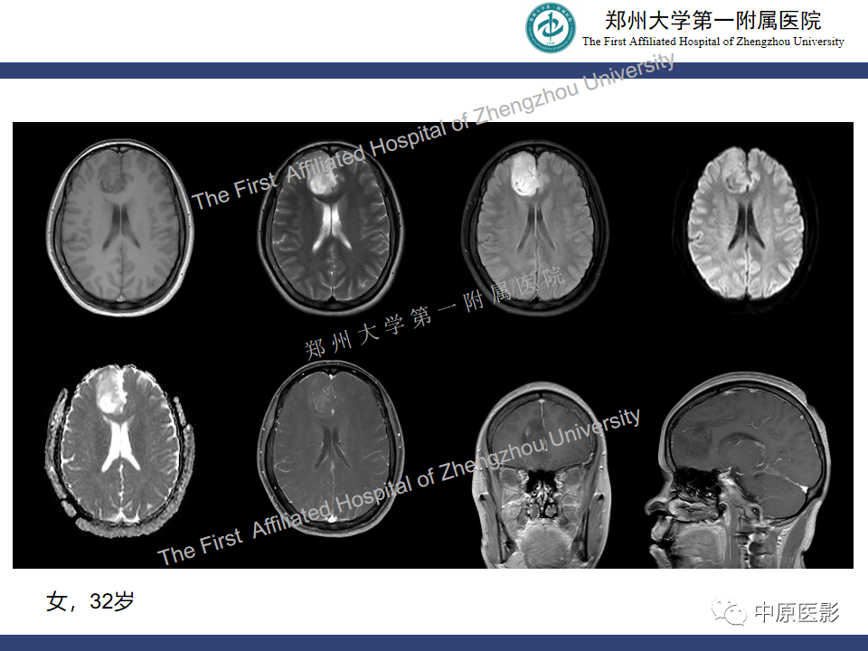 影像PPT - 【病例】颅内软骨肉瘤1例MR影像-22