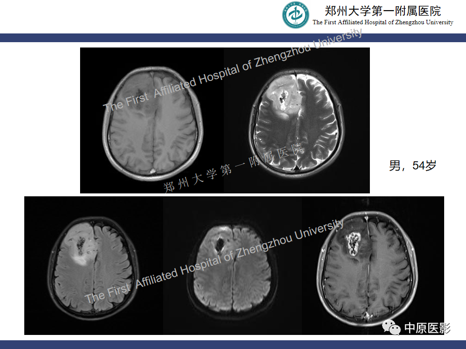 影像PPT - 【病例】颅内软骨肉瘤1例MR影像-23