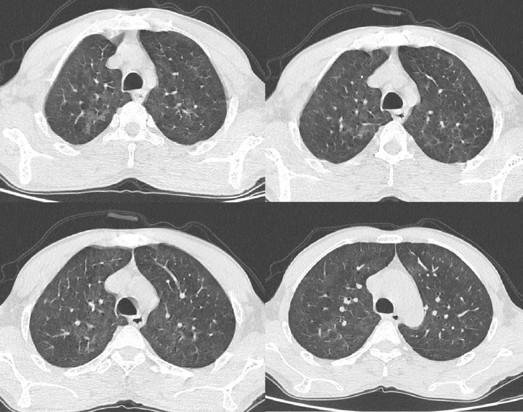 影像PPT - 【病例】艾滋病合并耶氏肺孢子菌肺炎2例胸部CT表现-4 影像PPT - 【病例】艾滋病合并耶氏肺孢子菌肺炎2例胸部CT表现-4