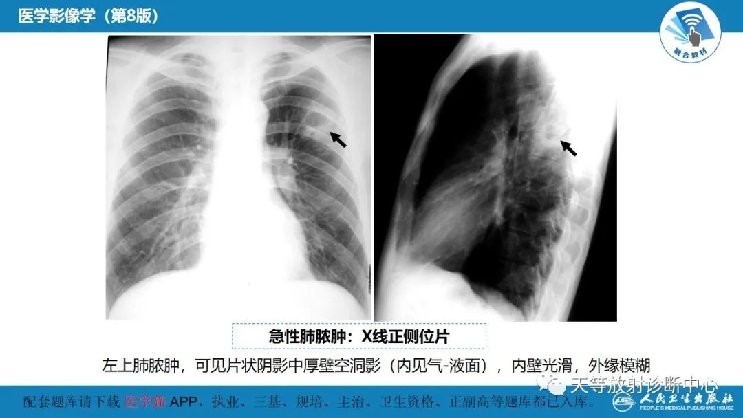 影像PPT - 【PPT】肺脓肿、肺结核影像诊断-8
