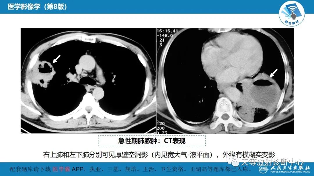 影像PPT - 【PPT】肺脓肿、肺结核影像诊断-9