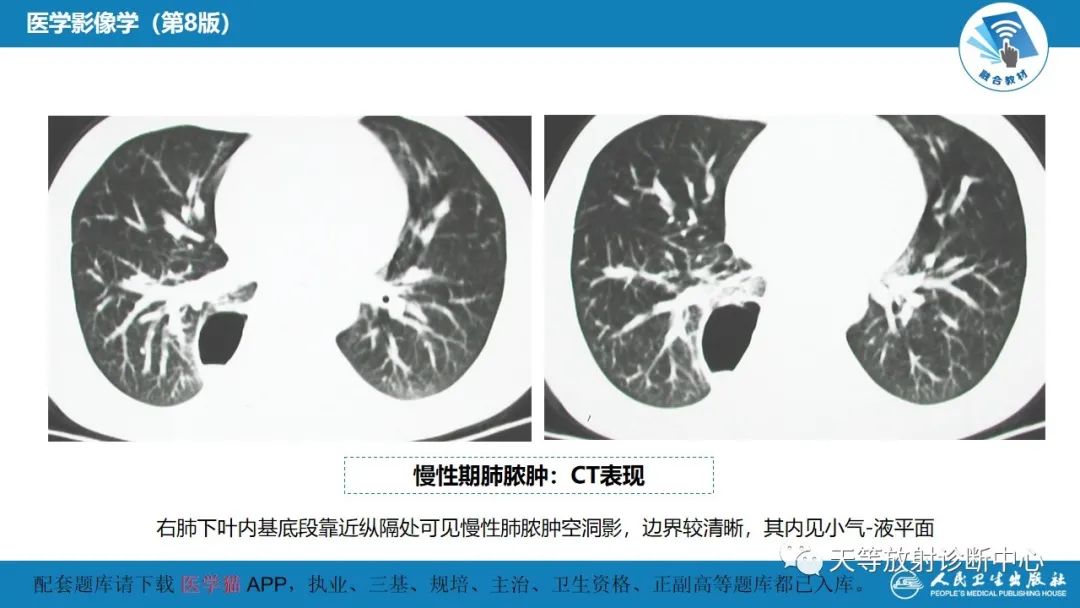 影像PPT - 【PPT】肺脓肿、肺结核影像诊断-11