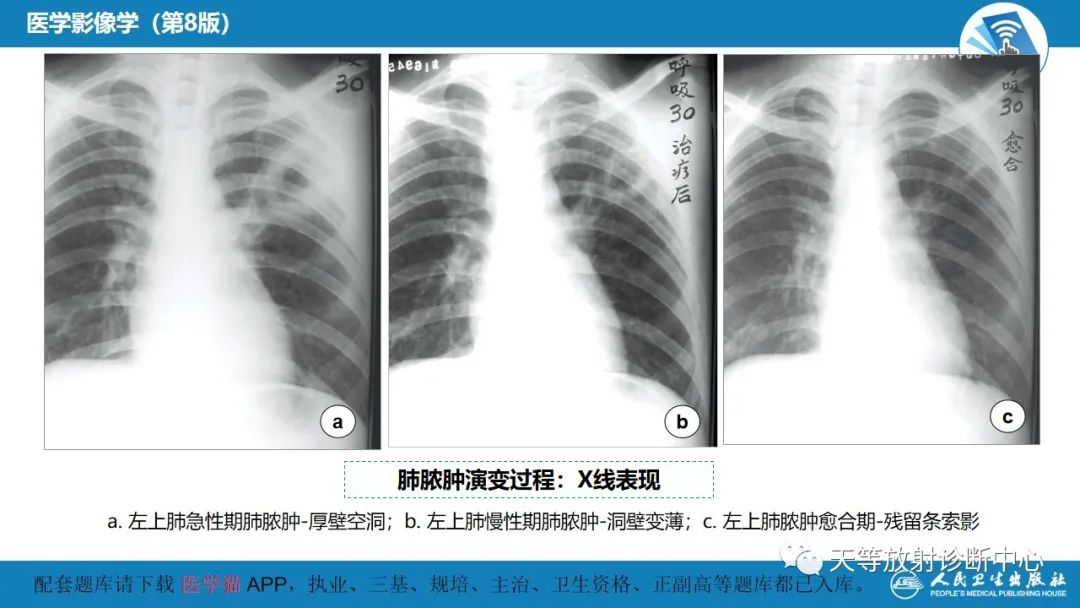 影像PPT - 【PPT】肺脓肿、肺结核影像诊断-12