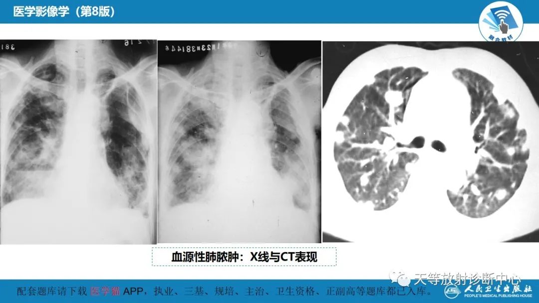影像PPT - 【PPT】肺脓肿、肺结核影像诊断-14