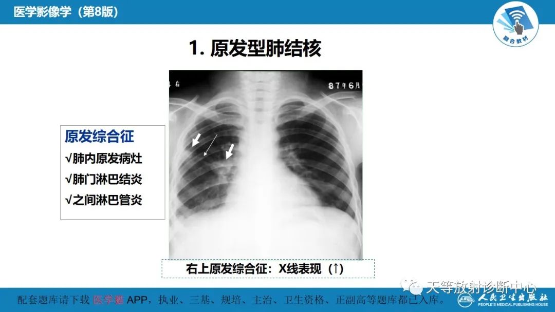 影像PPT - 【PPT】肺脓肿、肺结核影像诊断-18