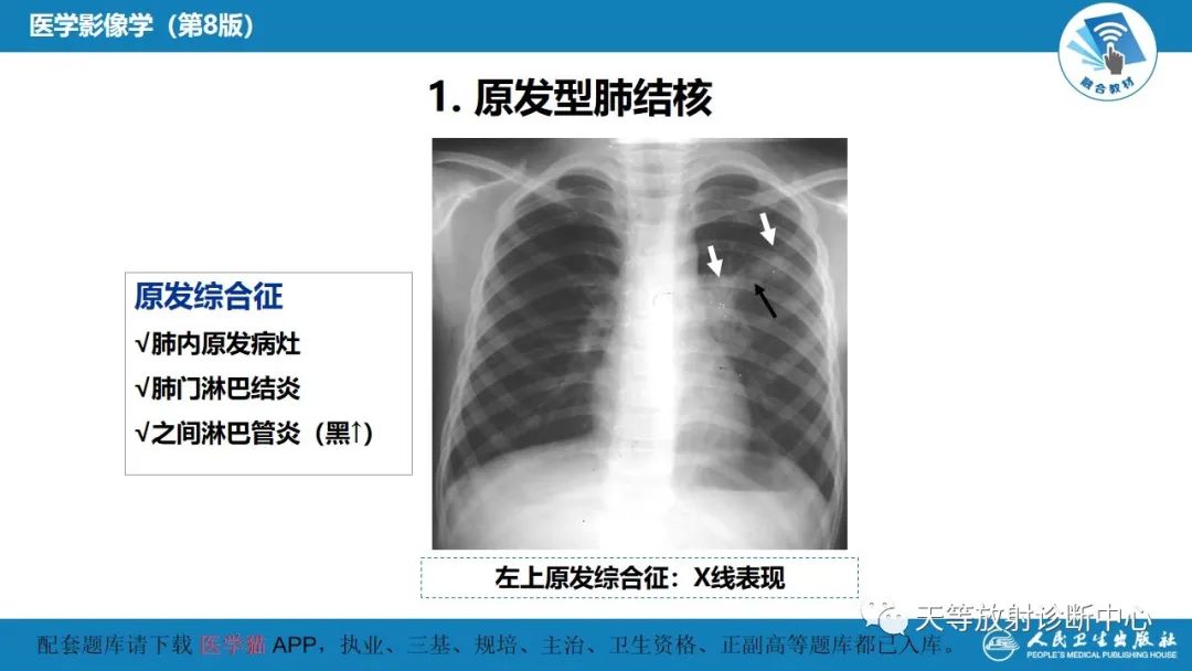 影像PPT - 【PPT】肺脓肿、肺结核影像诊断-19