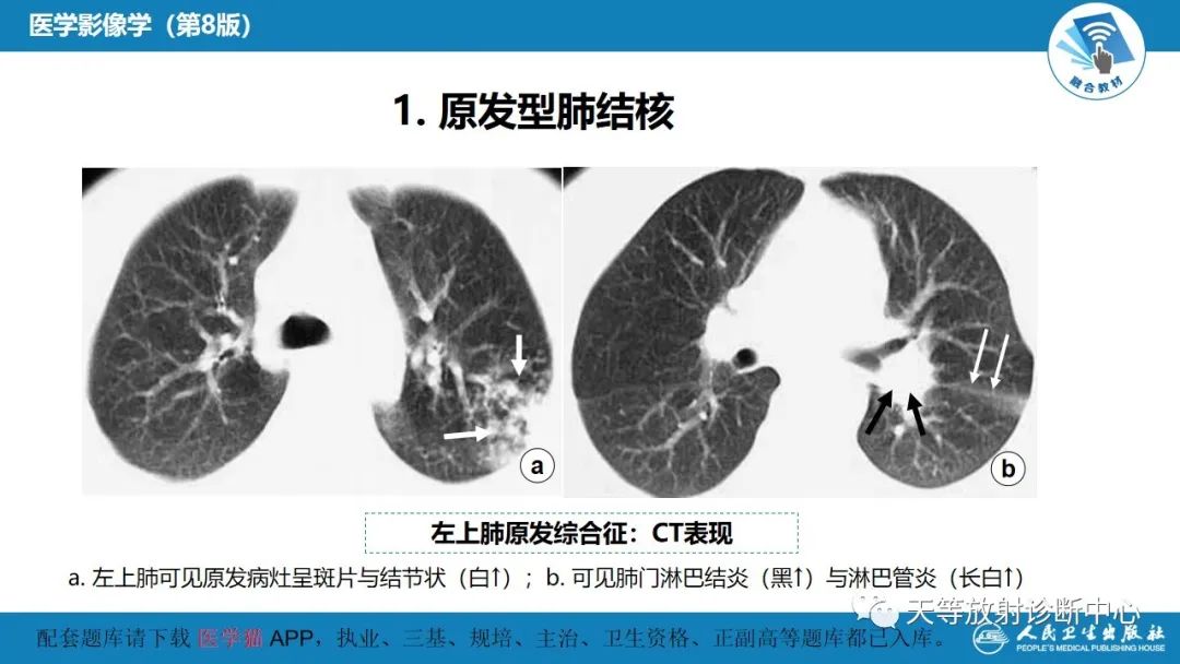 影像PPT - 【PPT】肺脓肿、肺结核影像诊断-20
