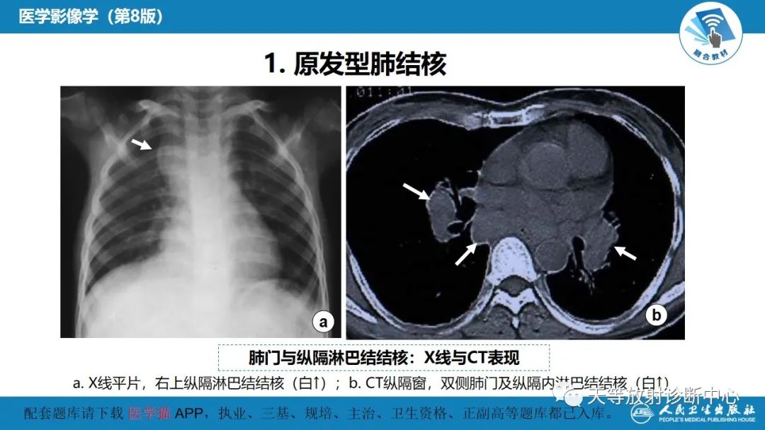 影像PPT - 【PPT】肺脓肿、肺结核影像诊断-21