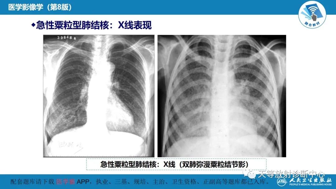 影像PPT - 【PPT】肺脓肿、肺结核影像诊断-23