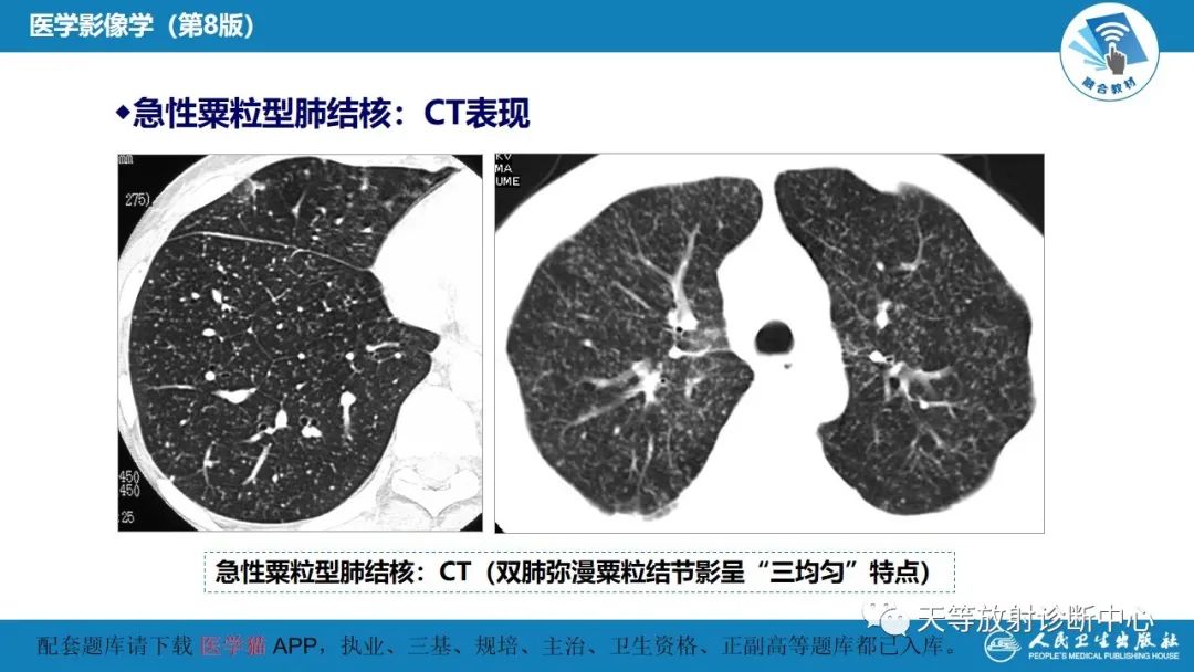 影像PPT - 【PPT】肺脓肿、肺结核影像诊断-24
