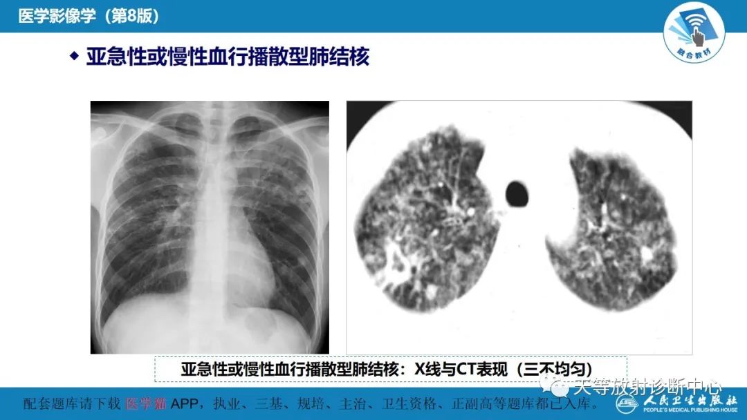 影像PPT - 【PPT】肺脓肿、肺结核影像诊断-26