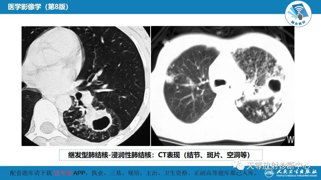 影像PPT - 【PPT】肺脓肿、肺结核影像诊断-30