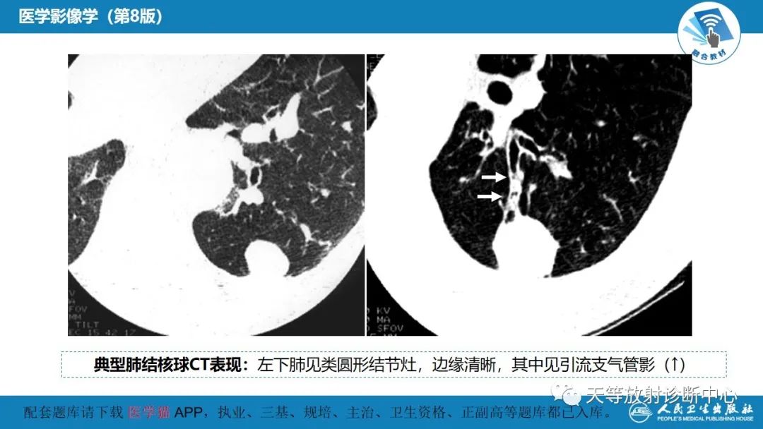 影像PPT - 【PPT】肺脓肿、肺结核影像诊断-31