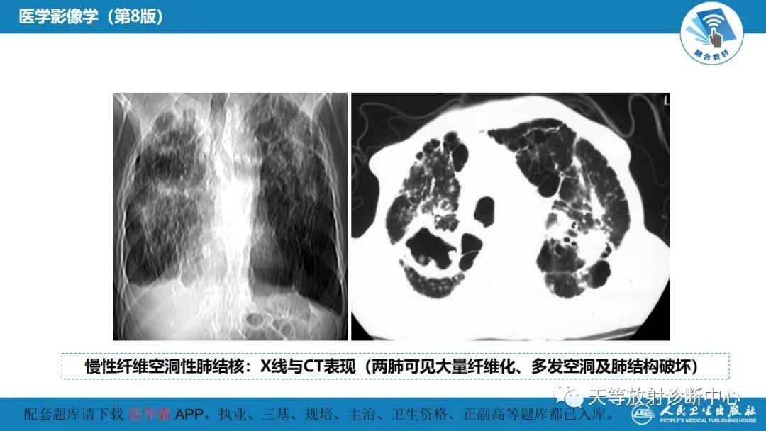 影像PPT - 【PPT】肺脓肿、肺结核影像诊断-32