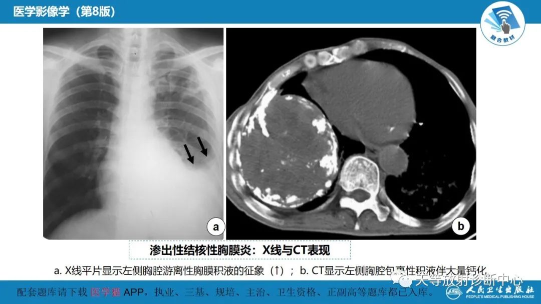 影像PPT - 【PPT】肺脓肿、肺结核影像诊断-34