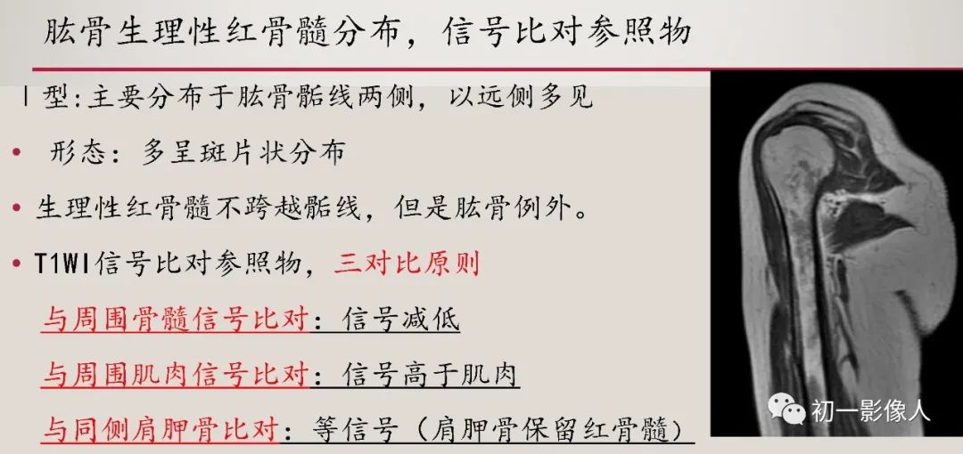 影像PPT - 【PPT】肱骨近端生理性红骨髓识别-5 影像PPT - 【PPT】肱骨近端生理性红骨髓识别-5