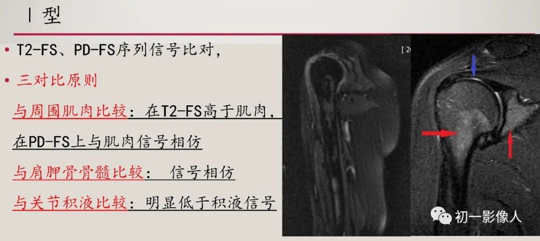 影像PPT - 【PPT】肱骨近端生理性红骨髓识别-6 影像PPT - 【PPT】肱骨近端生理性红骨髓识别-6
