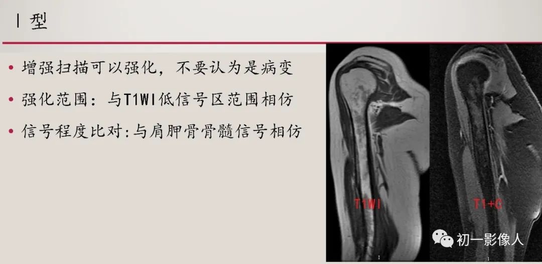 影像PPT - 【PPT】肱骨近端生理性红骨髓识别-7 影像PPT - 【PPT】肱骨近端生理性红骨髓识别-7