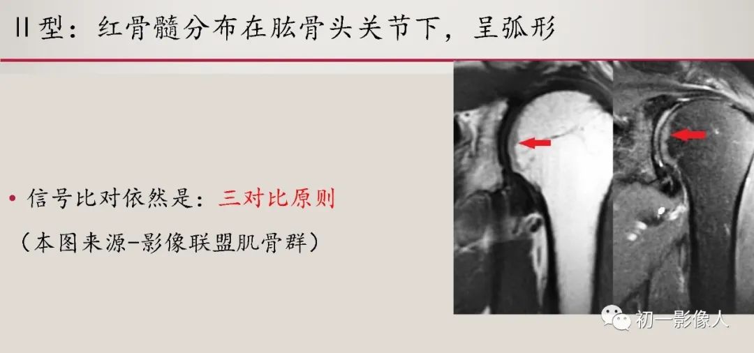 影像PPT - 【PPT】肱骨近端生理性红骨髓识别-8 影像PPT - 【PPT】肱骨近端生理性红骨髓识别-8