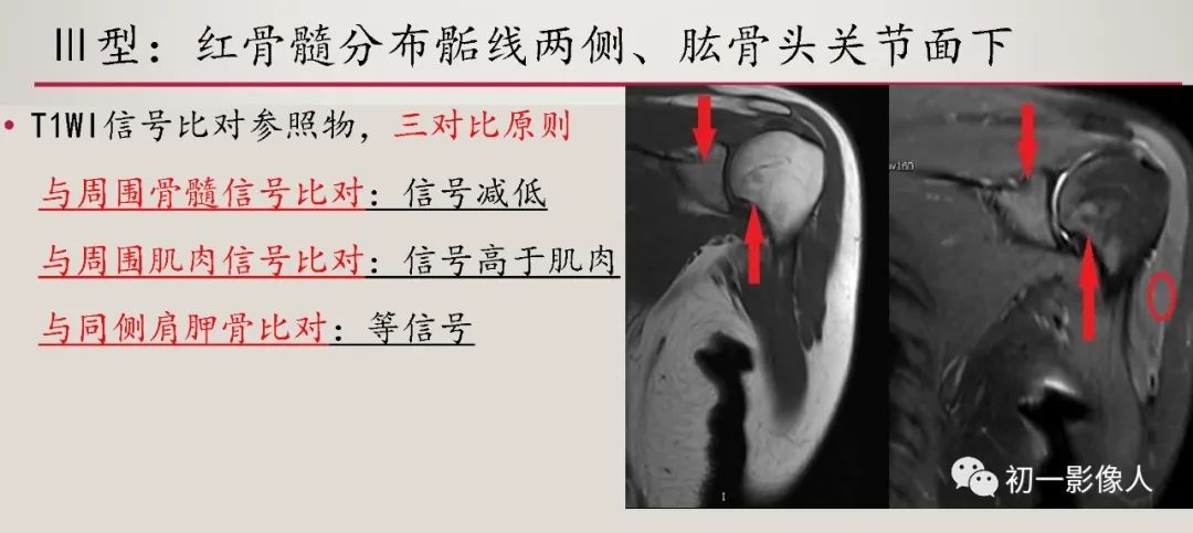 影像PPT - 【PPT】肱骨近端生理性红骨髓识别-9 影像PPT - 【PPT】肱骨近端生理性红骨髓识别-9