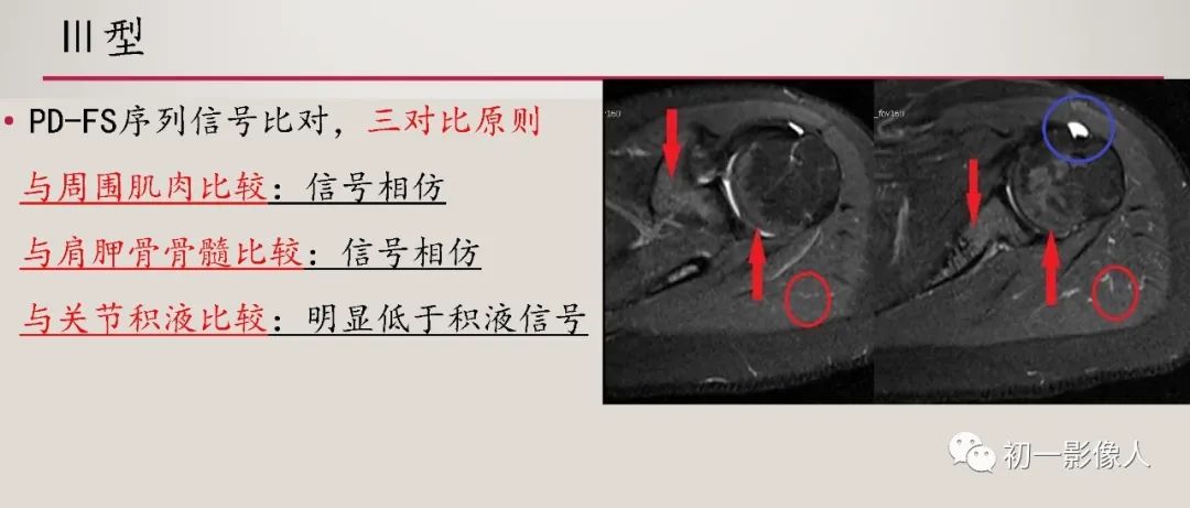 影像PPT - 【PPT】肱骨近端生理性红骨髓识别-10 影像PPT - 【PPT】肱骨近端生理性红骨髓识别-10