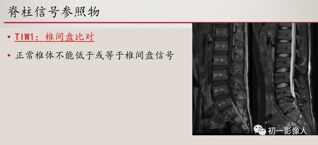 影像PPT - 【PPT】肱骨近端生理性红骨髓识别-11 影像PPT - 【PPT】肱骨近端生理性红骨髓识别-11