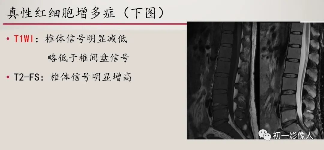 影像PPT - 【PPT】肱骨近端生理性红骨髓识别-12 影像PPT - 【PPT】肱骨近端生理性红骨髓识别-12