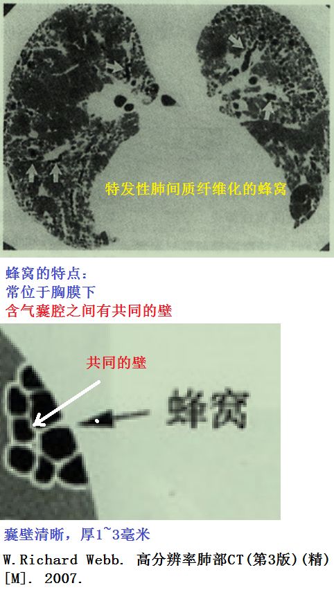 影像PPT - 肺大泡、肺气肿、肺的气囊、囊肿、空洞,CT如何鉴别-5 影像PPT - 肺大泡、肺气肿、肺的气囊、囊肿、空洞,CT如何鉴别-5