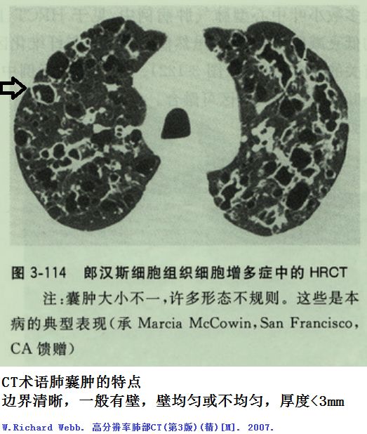 影像PPT - 肺大泡、肺气肿、肺的气囊、囊肿、空洞,CT如何鉴别-6 影像PPT - 肺大泡、肺气肿、肺的气囊、囊肿、空洞,CT如何鉴别-6