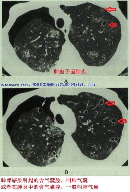 影像PPT - 肺大泡、肺气肿、肺的气囊、囊肿、空洞,CT如何鉴别-7 影像PPT - 肺大泡、肺气肿、肺的气囊、囊肿、空洞,CT如何鉴别-7