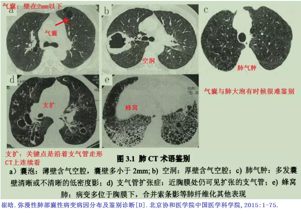 影像PPT - 肺大泡、肺气肿、肺的气囊、囊肿、空洞,CT如何鉴别-10 影像PPT - 肺大泡、肺气肿、肺的气囊、囊肿、空洞,CT如何鉴别-10
