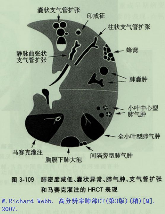 影像PPT - 肺大泡、肺气肿、肺的气囊、囊肿、空洞,CT如何鉴别-9 影像PPT - 肺大泡、肺气肿、肺的气囊、囊肿、空洞,CT如何鉴别-9