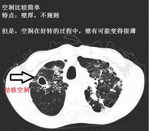 影像PPT - 肺大泡、肺气肿、肺的气囊、囊肿、空洞,CT如何鉴别-12 影像PPT - 肺大泡、肺气肿、肺的气囊、囊肿、空洞,CT如何鉴别-12