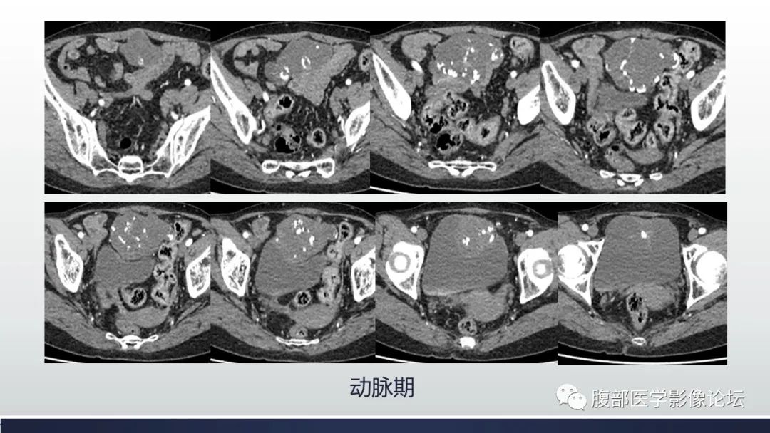 影像PPT - 【病例】脐尿管癌1例CT影像表现及鉴别诊断-4