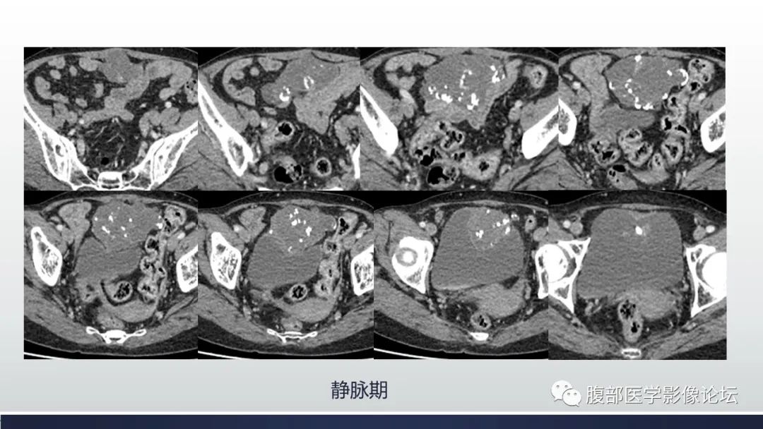 影像PPT - 【病例】脐尿管癌1例CT影像表现及鉴别诊断-5