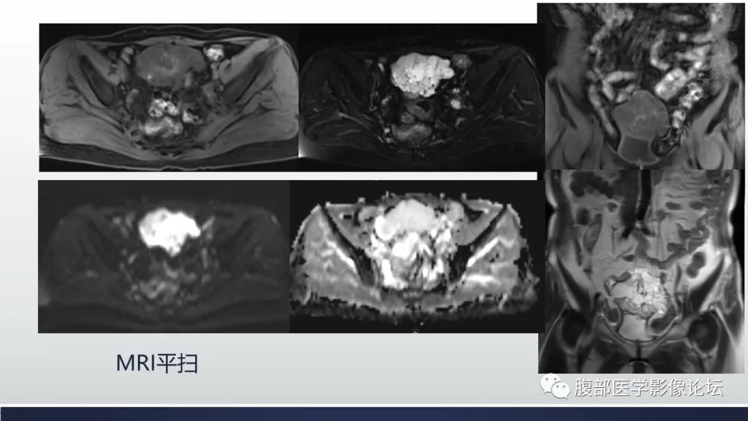 影像PPT - 【病例】脐尿管癌1例CT影像表现及鉴别诊断-7