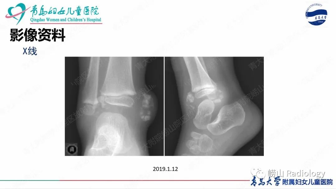 影像PPT - 【病例】半肢骨骺发育不良1例X线CT及MR-3