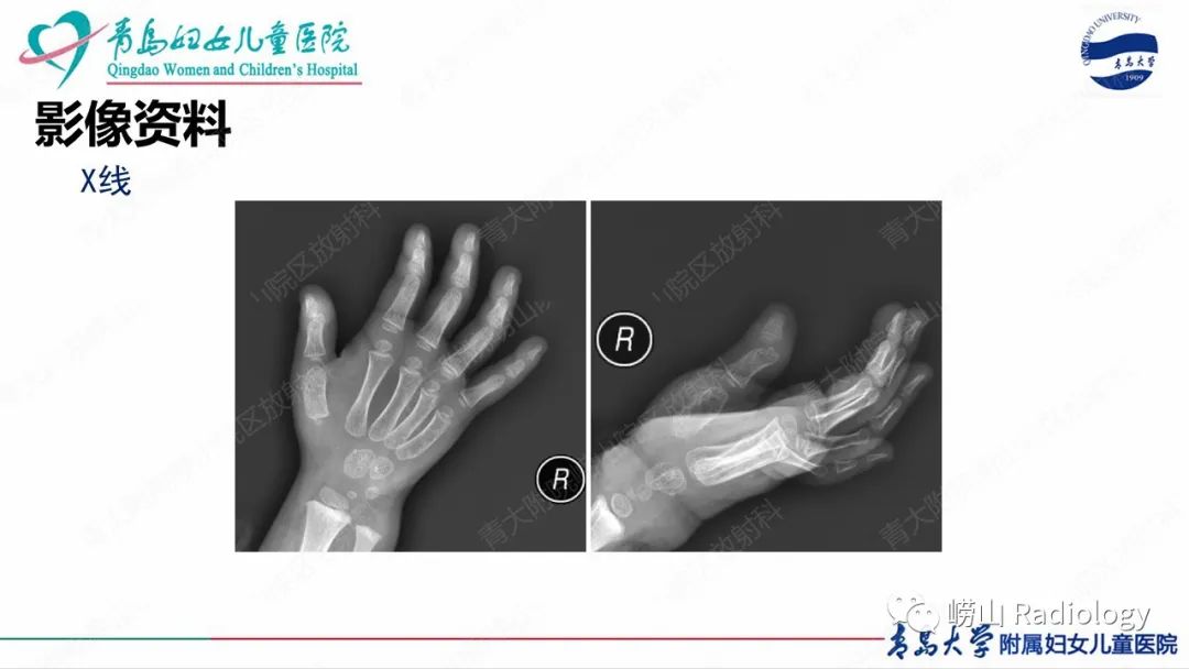 影像PPT - 【病例】半肢骨骺发育不良1例X线CT及MR-4