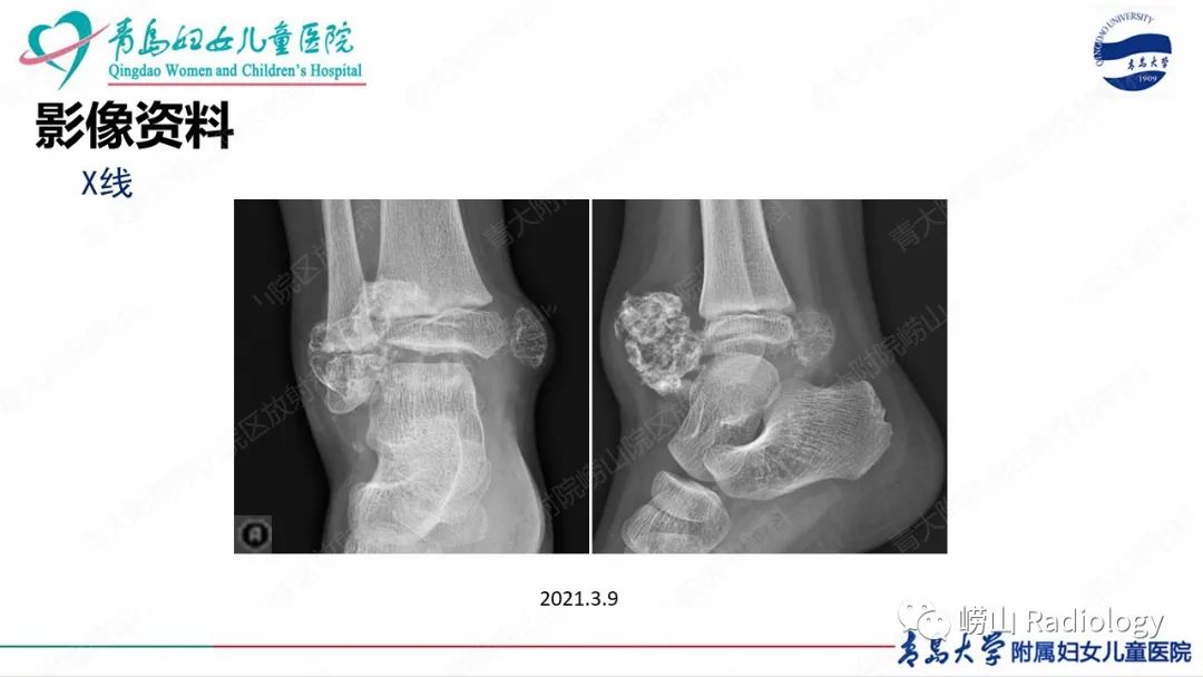 影像PPT - 【病例】半肢骨骺发育不良1例X线CT及MR-5