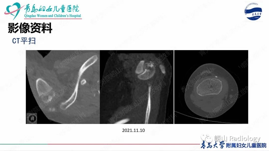 影像PPT - 【病例】半肢骨骺发育不良1例X线CT及MR-6