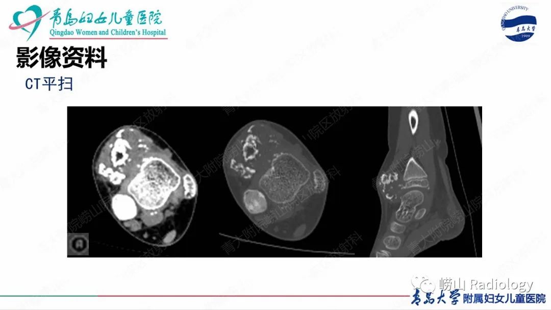 影像PPT - 【病例】半肢骨骺发育不良1例X线CT及MR-7