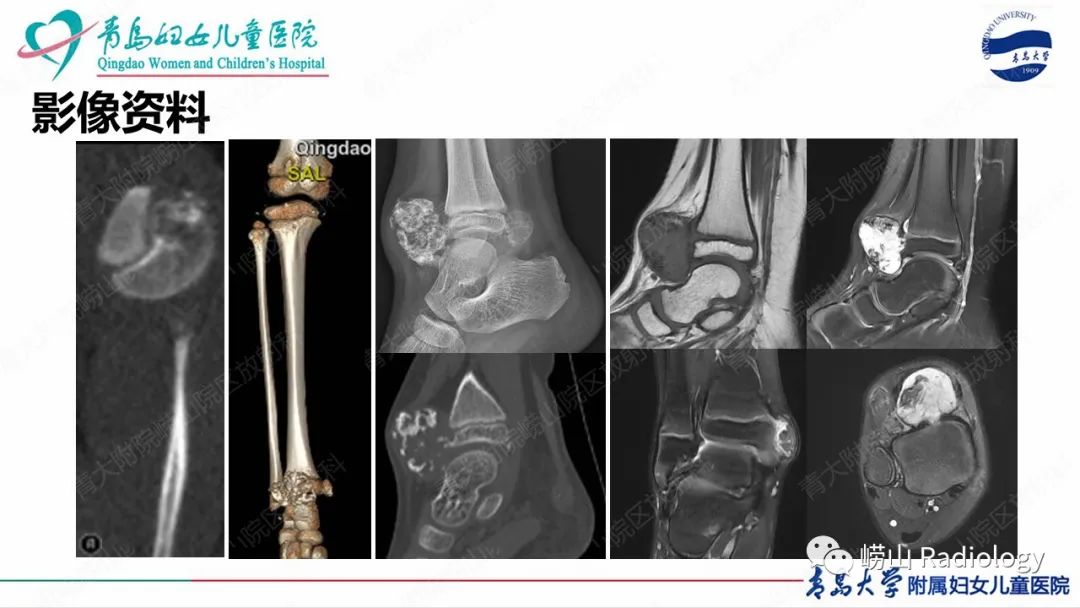 影像PPT - 【病例】半肢骨骺发育不良1例X线CT及MR-9