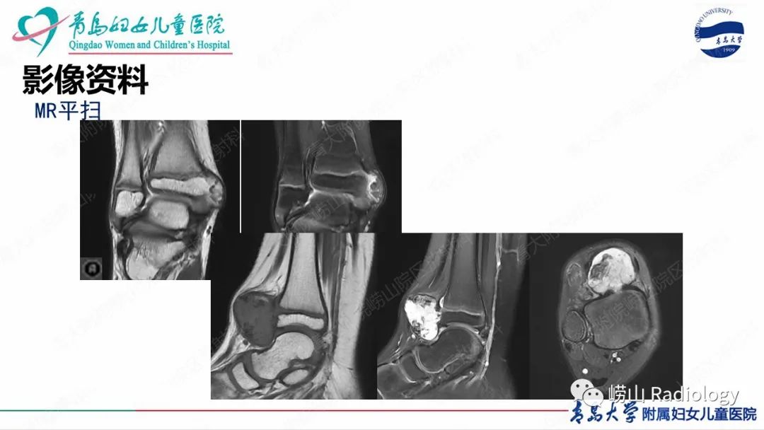影像PPT - 【病例】半肢骨骺发育不良1例X线CT及MR-8