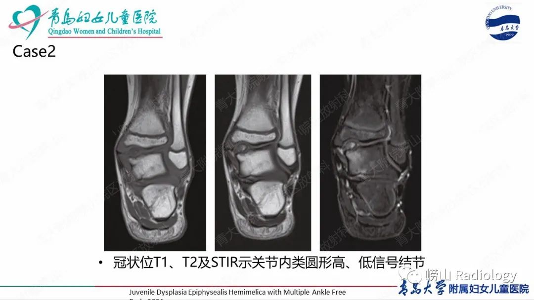 影像PPT - 【病例】半肢骨骺发育不良1例X线CT及MR-17