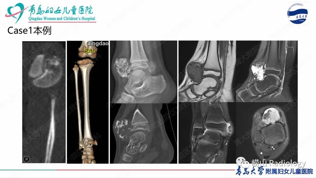 影像PPT - 【病例】半肢骨骺发育不良1例X线CT及MR-15
